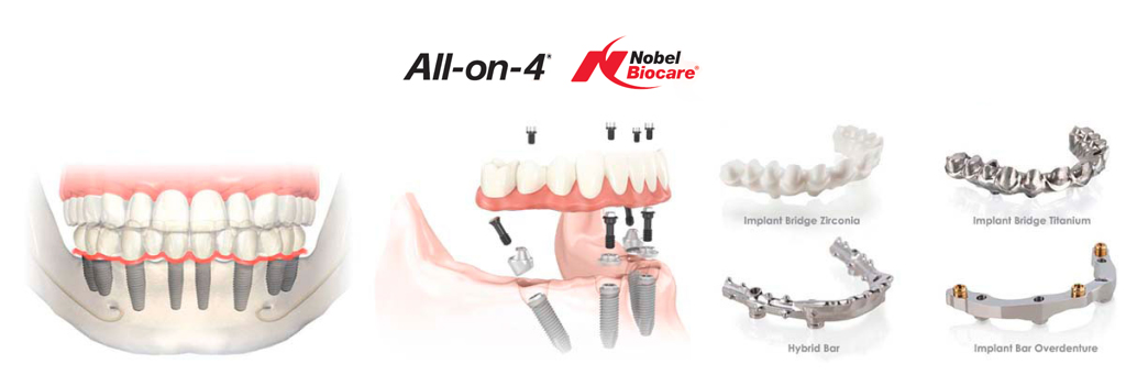 allon4-tower-dentistry